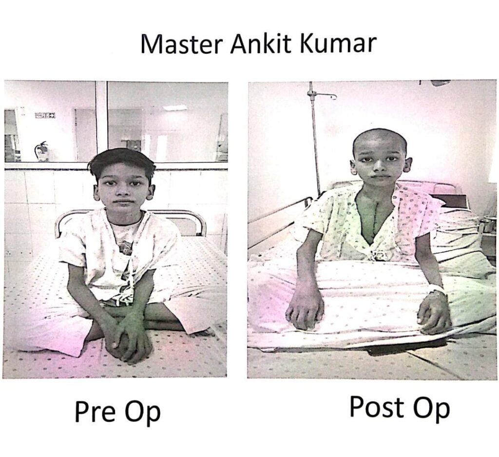 जन्मजात हृदय रोग से पीड़ित मरीज अंकित का निःशुल्क ओपेन हार्ट सर्जरी की गयी